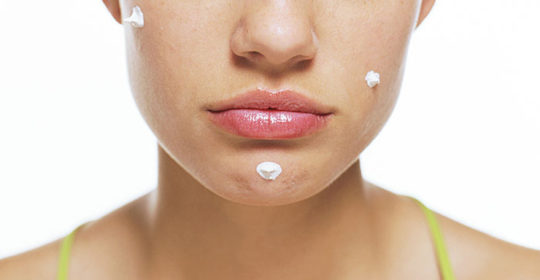 How to Prevent Pimples and Prevent Them from Coming Back